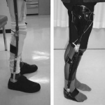 Long Leg Orthoses